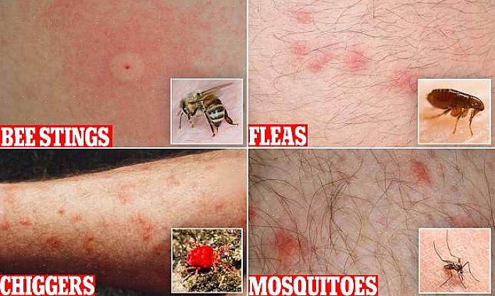 Het verschil tussen chiggerbeten en muggenbeten
